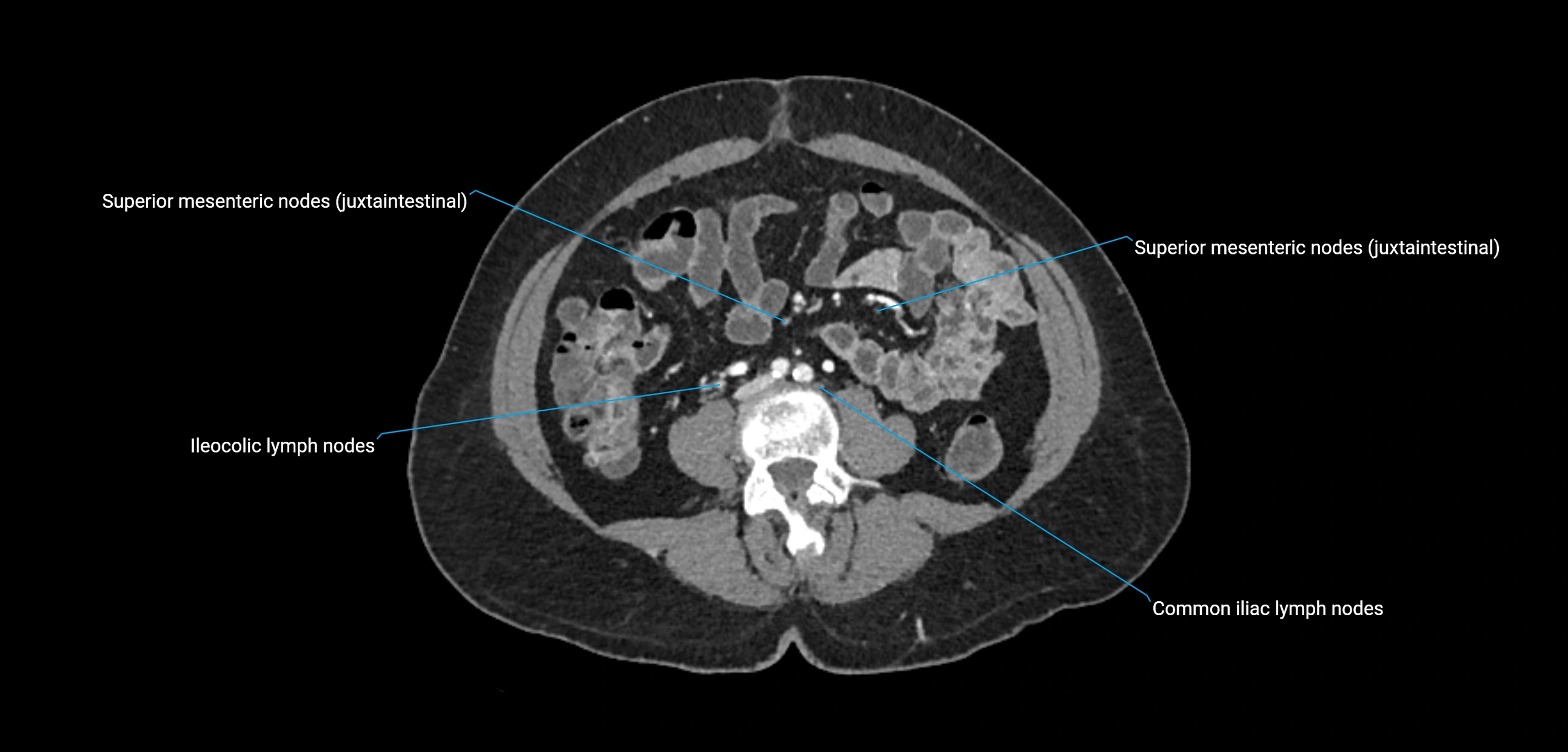 CT ct abdominal lymph nodes  axial cross sectional anatomy  enchanced radiology image -img-00002-00259.webp